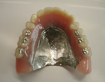 金属床義歯（Co-Cr鋳造床)